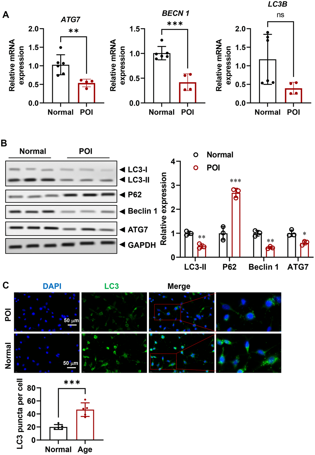 Attenuated autophagy in GCs from POI patients. (A) mRNA levels of autophagy-related genes in GCs (n = 4-6). (B) Representative Western blots (WB) and analysis of autophagy-related proteins in GCs (n = 3). (C) Representative IF staining and analysis of autophagy flux in GCs (n = 5). Scale bar, 50 μm. ns, no significant, *p 