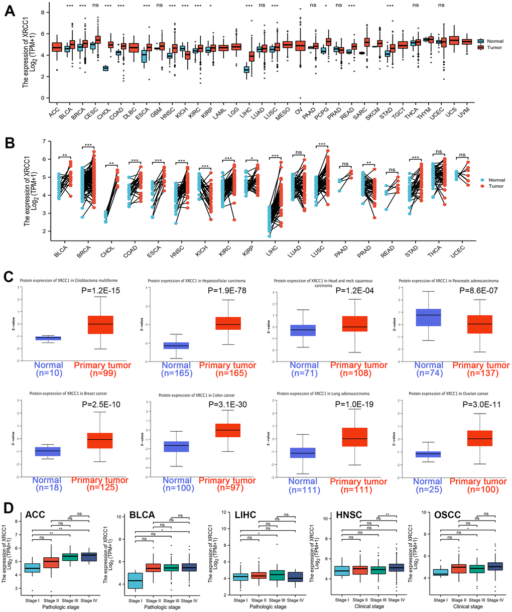 (A) Human XRCC1 gene expression status in various cancers from TCGA database. (B) Wilcoxon signed rank sum test was used to detect the differential expression of XRCC1 in tumor tissues and adjacent paracancerous tissues. (C) The protein expression level of the XRCC1 gene in glioblastoma multiforme, hepatocellular carcinoma, head and neck squamous carcinoma, pancreatic adenocarcinoma, breast cancer, ovarian cancer, colon cancer, lung adenocarcinoma, clear cell RCC. (D) The box plot of tumor pathological stages (stage I, stage II, stage III, stage IV) following ACC, BLCA, LIHC, and clinical stages (stage I, stage II, stage III, stage IV) of HNSC, OSCC. ns P≥0.05, *P