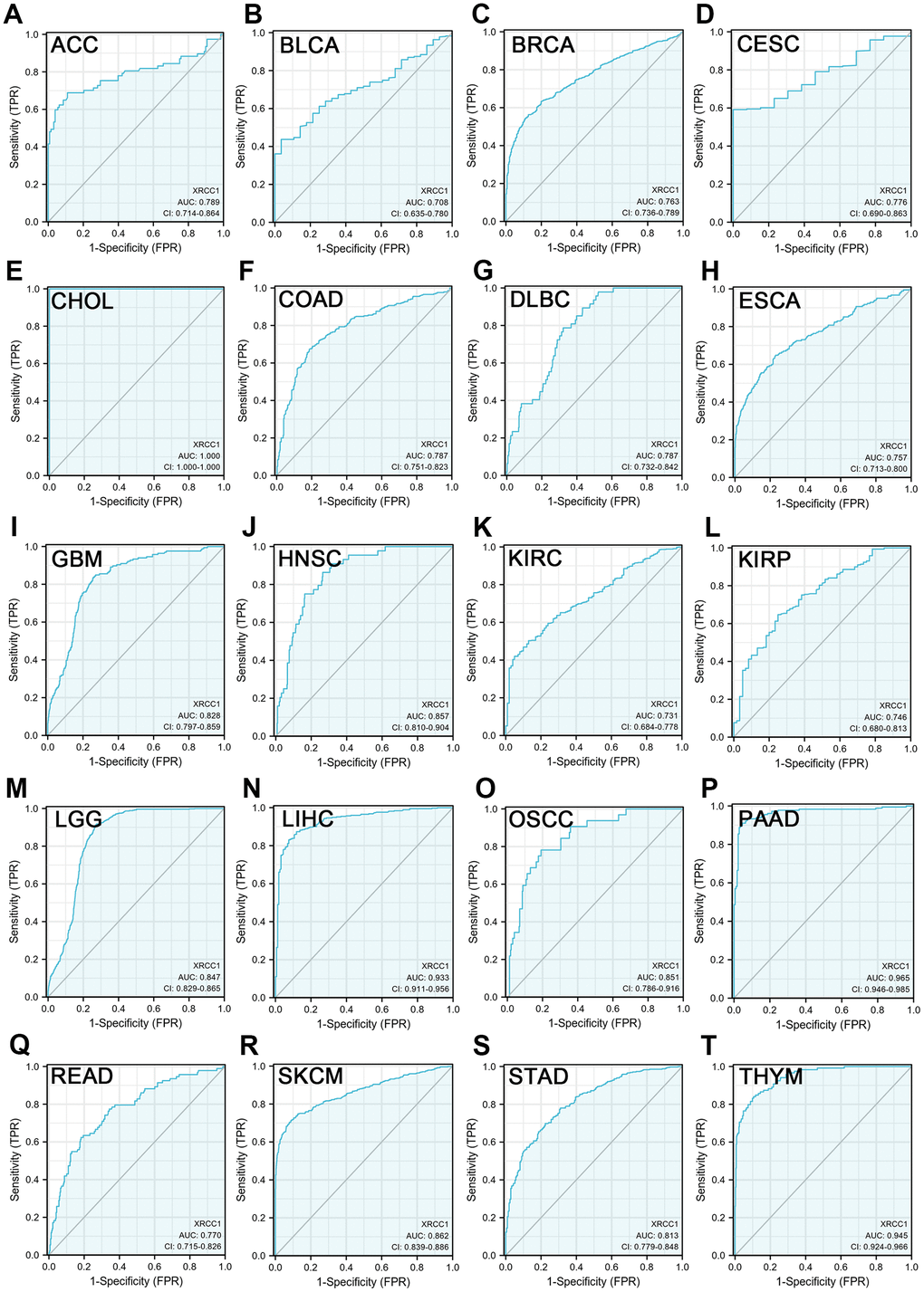 XRCC1 expression levels could distinguish between cancerous and normal tissues in pan-cancer. (A) ACC; (B) BLCA; (C) BRCA; (D) CESC; (E) CHOL; (F) COAD; (G) DLBC; (H) ESCA; (I) GBM; (J) HNSC; (K) KIRC; (L) KIRP; (M) LGG; (N) LIHC; (O) OSCC; (P) PAAD; (Q) READ; (R) SKCM; (S) STAD; (T) THYM. X-axis reveals the false positive rate, while Y-axis indicates the true positive rate.