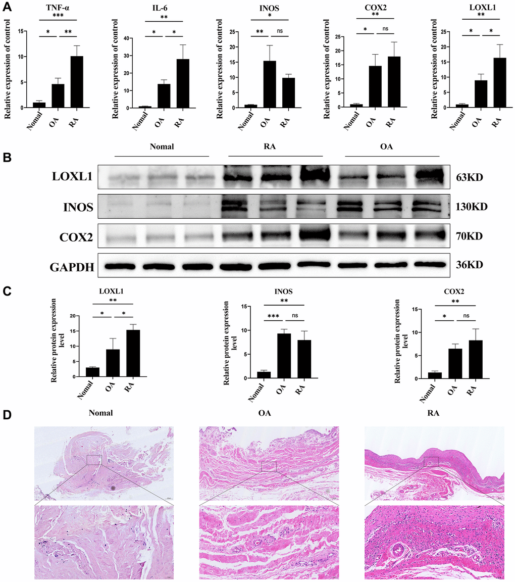 LOXL1 expression in human RA synovial membrane. (A) Expression of LOXL1, TNF-α, IL-6, INOS and COX2 was detected in RA synovium, OA synovium and normal synovium by qPCR. (B) LOXL1, INOS and COX2 protein expression level was assessed in RA synovium, OA synovium and normal synovium using western blot. (C) Quantitative analysis of western blot results. (D) HE staining of RA synovium, OA synovium and normal synovium. Low magnification scale bar = 200 μm and High magnification scale bar = 50 μm. *P **P ***P 