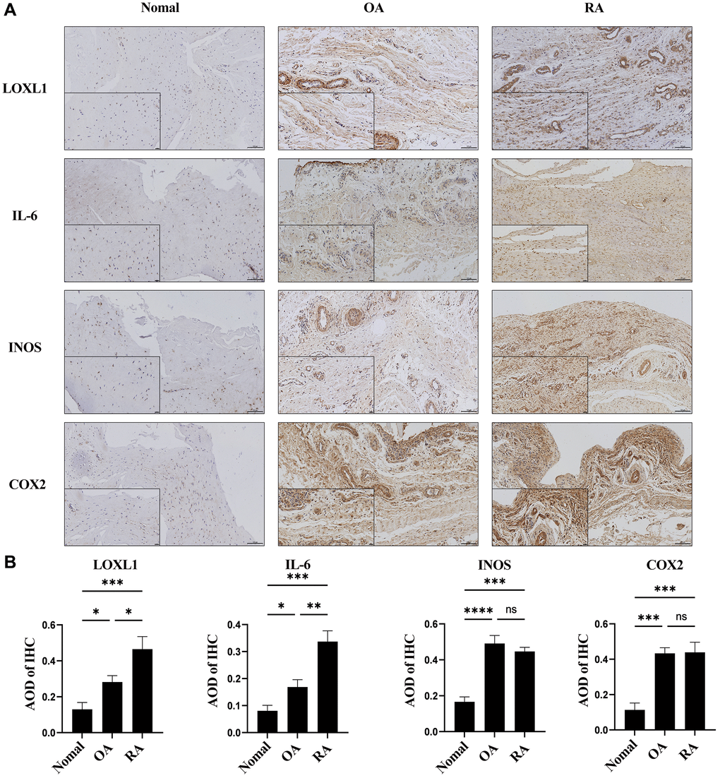 LOXL1 expression was measured in RA synovium, OA synovium, and normal synovium through immunohistochemistry (A) and its quantitative analysis (B). Low magnification scale bar = 100 μm and High magnification scale bar = 20 μm. *P **P ***P ***P 