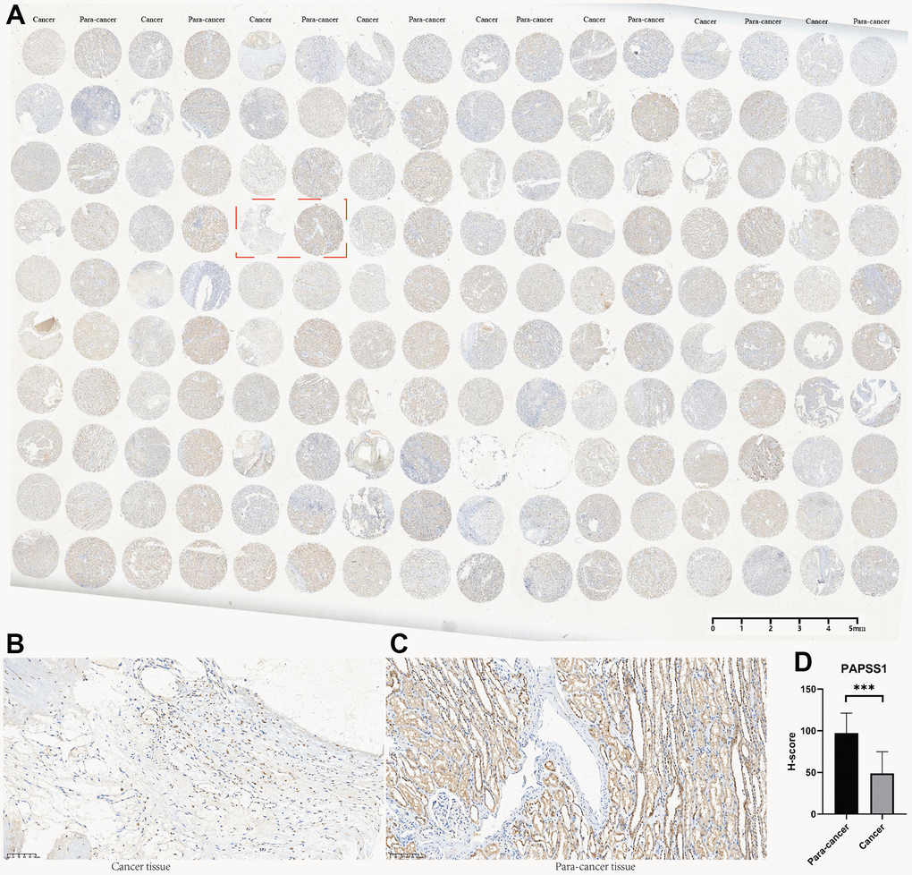 The tissue microarray and immunohistochemistry (IHC) of PAPSS1. (A) Immunohistochemical maps for all samples. (B) Immunohistochemical maps of typical cancer samples. (C) Immunohistochemical maps of typical para-cancer samples. (D) Immunohistochemical statistical analysis results.
