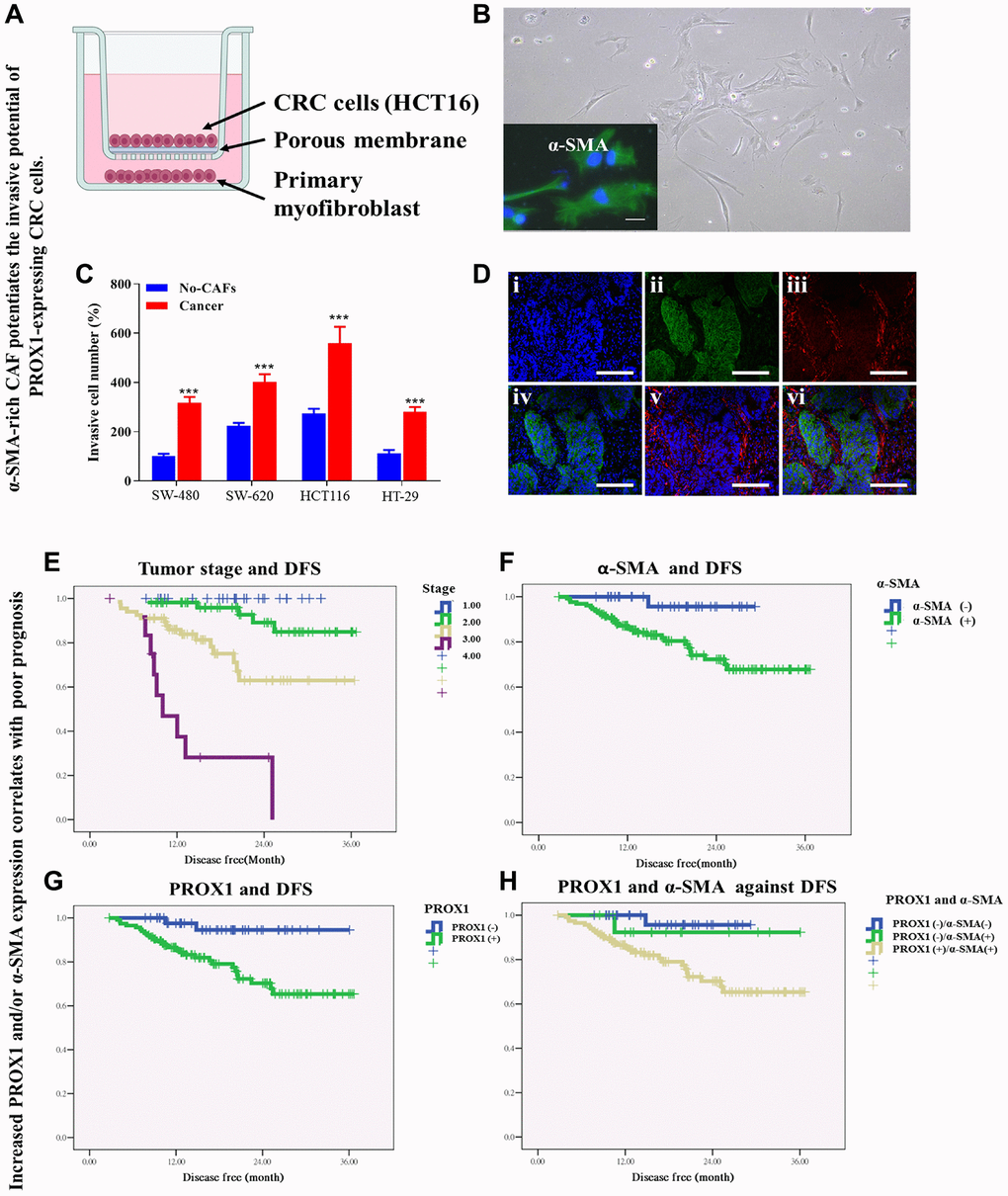 α-SMA-rich CAF potentiates the invasive potential of PROX1-expressing CRC cells. (A) Schematic representation of α-SMA-rich CAF co-cultured with PROX1-expressing CRC (HCT116) cells. (B) Micrograph of α-SMA-rich CAF, with inserted immunofluorescent staining of α-SMA. (C) Invasion assay shows SW-480, SW-620, HCT116 and HT-29 cells co-cultured with α-SMA-rich CAF acquired increased invasive potential compared to their counterparts which were not co-cultured with the CAF. (D) Immunofluorescence staining of PROX1 and/or α-SMA in CRC tissue sample. Blue – DAPI, Green – PROX1 and Red – α-SMA. Survival rate analysis of colorectal cancer patients. Kaplan-Meier curve analysis shows a correlation between (E) tumor stage and disease-free survival, DFS, (F) PROX1 expression and DFS, (G) α-SMA expression and DFS, and (H) co-expression of PROX1 with α-SMA, and DFS.