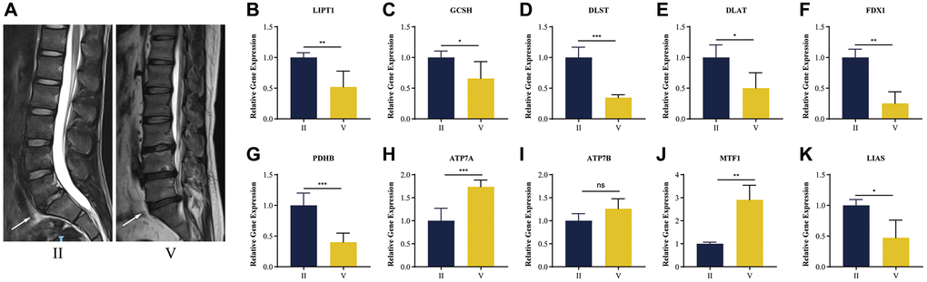 RT-qPCR validation of human NP tissue. (A) Typical human MR T2-weighted images of grade II and grade IV. The degenerated discs were indicated by white arrows. (B–K) Cuproptosis genes FDX1, LIAS, LIPT1, GCSH, DLST, DLAT, PDHB, exhibited significantly lower expression levels in IDD NP samples than controls, while ATP7A, ATP7B and MTF1 displayed the opposite results. All results were expressed as mean ± standard deviation. *p **p ***p 