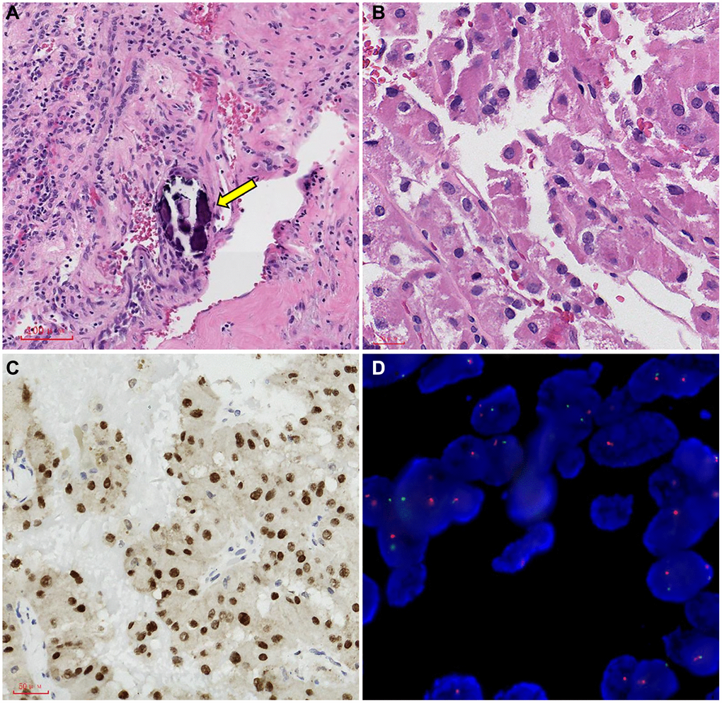 Representative images of TFE3 immunohistochemical staining and microscopic appearance for Xp11.2 RCC. (A) Blood sinusoid and Psammoma bodies were abundant in intercellular substance. The arrow points to Psammoma bodies; (B) abundant and deeply stained eosinophile cytoplasm, similar to renal clear cell carcinoma; (C) the results of immunohistochemistry showed that TFE3 was strongly positive in cancerous tissue; (D) FISH test results: 100 cells were counted, and the number of cells with TFE3 gene breakage was more than 20. TFE3 gene probe: Broken (positive).