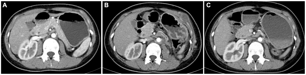 Contrast-enhanced computed tomography results of postoperative follow-up in a patient with TFE3-RCC. (A) The results of re-examination one month after the surgery; (B) three months after surgery, the patient’s re-examination showed multiple tumor metastases in the abdominal wall, left psoas major muscle, and pelvic cavity, so the patient started sunitinib therapy; (C) the re-examination results at six months after surgery showed that the metastasis was smaller than before, and the disease progression was controlled.