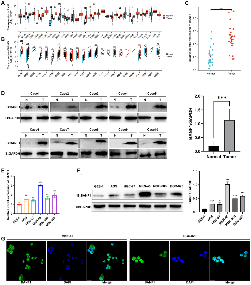 Expression and localization of BANF1. (A) BANF1 expression among pan-cancer unpaired samples in the TCGA database. (B) BANF1 expression among paired samples of pan-cancer in the TCGA database. (C) RT-qPCR detection of BANF1 mRNA expression in 23 pairs of GC tissues and paired paracancerous tissues. (D) WB detection of BANF1 protein expression in 10 pairs of GC tissues, and the difference of gray values between gastric cancer tissues (n = 10) and adjacent tissues (n = 10) were compared. (E) RT-qPCR was used to detect the expression of BANF1 mRNA in GC cell lines (AGS, HGC-27, MKN-45, MGC-803, BGC-823) and gastric mucosal epithelial cell line (GES-1), respectively. (F) The expression of BANF1 protein in 6 cell lines was detected by WB, and the gray values of gastric cancer cell lines (AGS, HGC-27, MKN-45, MGC-803, and BGC-823) and gastric epithelial cells (GES-1) were compared. (G) Immunofluorescence staining showed the expression and localization of BANF1 protein in MKN-45 and BGC-823 cells. All experiments were repeated at least three times. ns means no statistical difference, *p **p ***p 