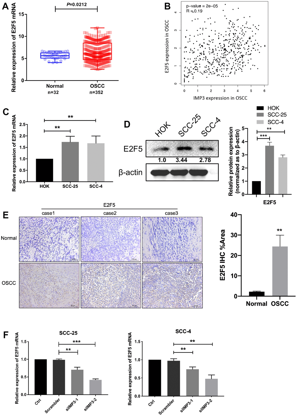 IMP3 positively regulated E2F5. (A) TCGA analysis showed that E2F5 mRNA levels were increased in the OSCC tissues (n=352) compared with the normal tissues (n=32). (B) Pearson correlation analysis of IMP3 and E2F5 expression in OSCC showed that IMP3 is positively correlated with E2F5. (C, D) qRT-PCR and Western blot assay showed that E2F5 was upregulated in OSCC cell lines (SCC-25 and SCC-4) in comparison with HOK cell line. (E) Representative images of IHC staining of E2F5 protein in OSCC tissues (n=40). Magnification ×40. The scale bar indicates 50 μm. (F) Quantification of E2F5 transcripts in SCC-25 and SCC-4 after transfection with siIMP3. Relative expression levels were calculated using the image J software (n = 3). P ≤ 0.05 was considered to be statistically significant, **P P 