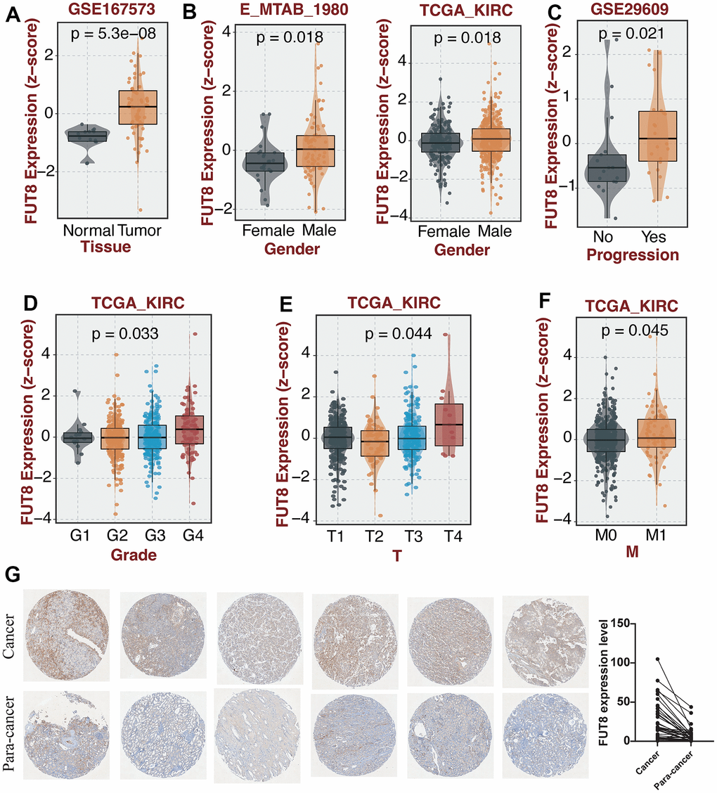 The investigation of the molecular features of FUT8 in KIRC through subgroup analysis and IHC. (A–F) The comparison of FUT8 expression in distinct KIRC subgroups. (G) Expression validation of FUT8 in KIRC and para-cancer.