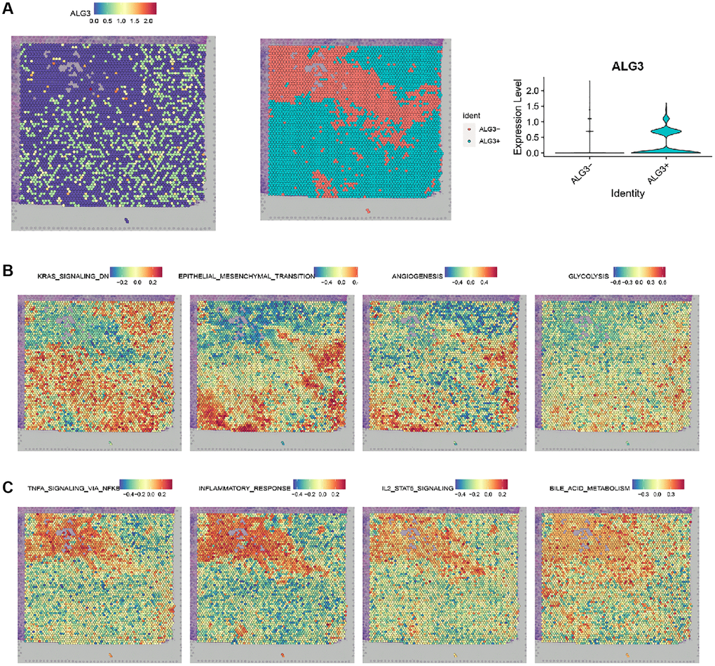 Spatially mapping the association of ALG3 expression level and significant pathways in breast cancer. (A) Spatial plots showing the expression level of ALG3. (B) Spatial plots showing spatial spots colored by subclusters. (C) Spatial plots showing GSVA scores of pathways.