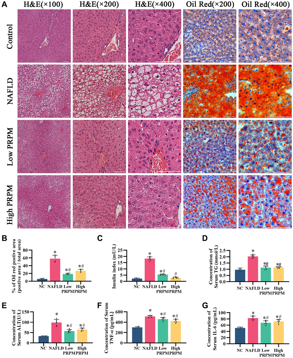PRPM improves nonalcoholic fatty liver disease. (A) H&E staining, ×100, ×200, ×400; Oil red staining, ×200, ×400. (B) Quantitative analysis of the Oil red O staining-positive area (%). (C–G) ELISA analysis of the insulin index, serum triglycerides (TG), alanine aminotransferase (ALT), tumor necrosis factor-α (TNF-α), and interleukin-6 (IL-6). *indicates a comparison with NC, P #indicates a comparison with NAFLD, P 