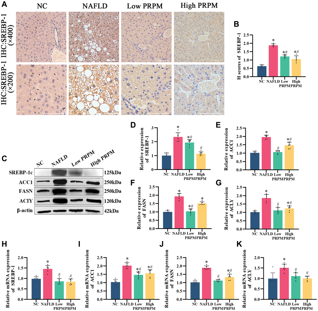 PRPM mediates the AMPK signaling pathway in NAFLD. (A) IHC staining of SREBP-1, ×200, ×400. (B) A correlation analysis of the H-scores of SREBP-1. (C) Representative Western blot of SREBP-1, ACC1, FASN, and ACLY. (D–G) Western blot analysis. (H–K) Relative mRNA levels of SREBP-1, ACC1, FASN, and ACLY (ratio: measured mRNA/GAPDH mRNA). *indicates comparison with NC, P #indicates a comparison with NAFLD, P 