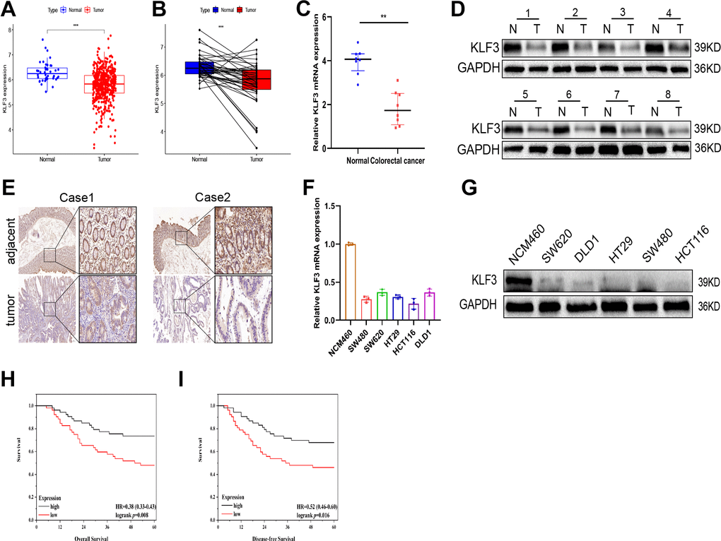 Association of KLF3 down-regulation with prognosis in CRC patients. (A, B) KLF3 expression was significantly lower in 488 CRC specimens compared to 42 adjacent non-CRC specimens, and in matched CRC specimens compared to matched normal colon specimens. The data is presented as (-log10) for KLF3 expression (fpkm). The line shows the average value. (C, D) mRNA and protein levels of KLF3 measured by qPCR and western blotting, respectively, in eight pairs of randomly selected CRC tissues and normal samples. (E) Immunohistochemistry analysis of the expression of KLF3 protein in CRC and normal samples. (F, G) KLF3 mRNA and protein expressions were higher in NCM460 than in normal CRC cell lines. (H, I) Kaplan-Meier curves showing reduced overall survival (OS) and disease-free survival (DFS) in patients with low KLF3 mRNA levels. Scale bars: 50 μm. *p 