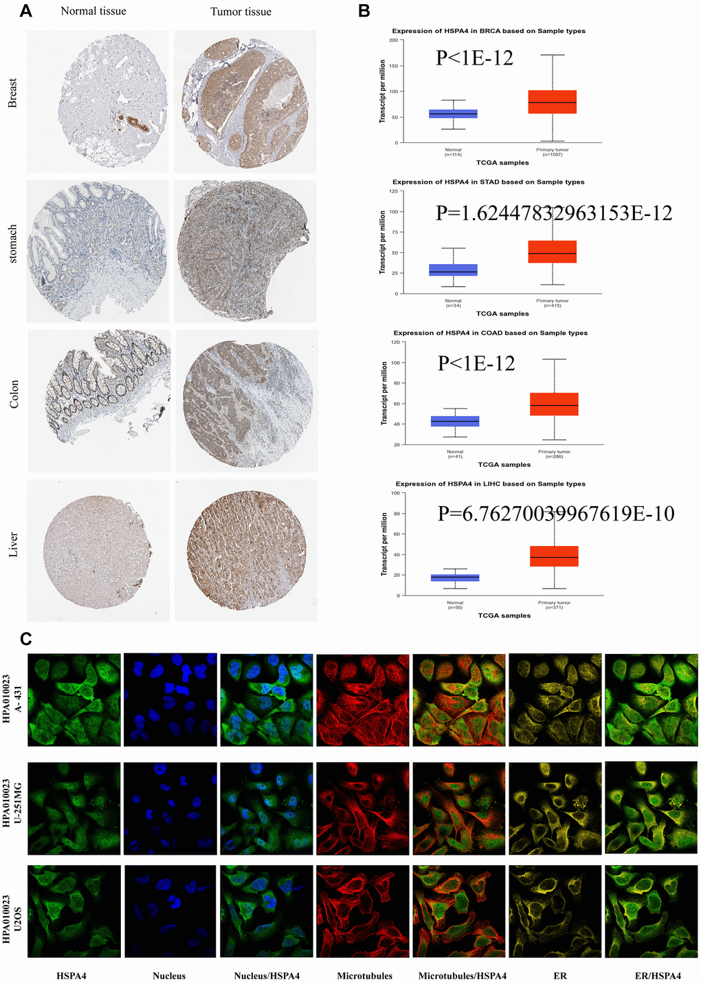 The expression of HSPA4 protein in different cancers. (A) Based on the HPA database (http://www.proteinatlas.org/), the expression of HSPA4 protein in normal or tumor tissue of breast, stomach, colon, liver, and thyroid was displayed (images available from https://www.proteinatlas.org/ENSG00000170606-HSPA4/). (B) Based on the UALCAN database, the expression of HSPA4 protein in normal or tumor tissue of breast, stomach, colon, liver, and thyroid was displayed (dates available from https://ualcan.path.uab.edu/analysis.html). (C) Immunofluorescence staining of the subcellular localization of HSPA4 in HPA database (images available from https://www.proteinatlas.org/ENSG00000170606-HSPA4/subcellular#human).