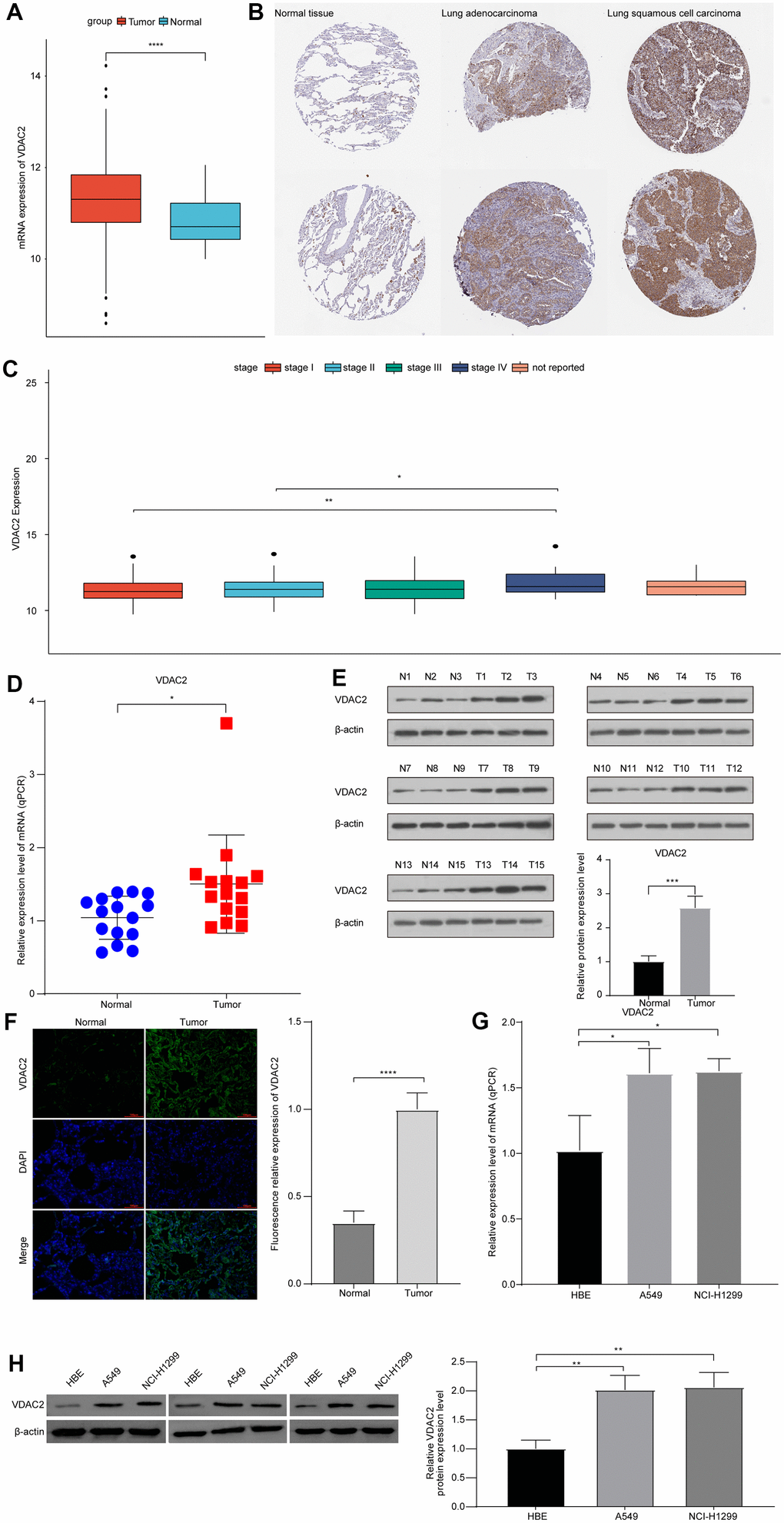 Hypoxia heterogeneous NSCLC subpopulation related VDAC2 showed important prognostic value and tumor promoting role in NSCLC. (A) The expression of VDAC2 in normal and cancer samples basing on TCGA-LUAD cohort. (B) The expression of VDAC2 in NSCLC tissues and normal tissues basing on Human protein atlas database. (C) The expression of VDAC2 in different stages of NSCLC patients. (D, E) The levels of VDAC2 mRNA and protein in clinical NSCLC tissues. (F) The expression of VDAC2 in lung cancer and adjacent noncancerous tissues was detected by immunofluorescence. (G, H) The levels of VDAC2 mRNA and protein expression in A549 and NCI-H1299 cells. * ppp