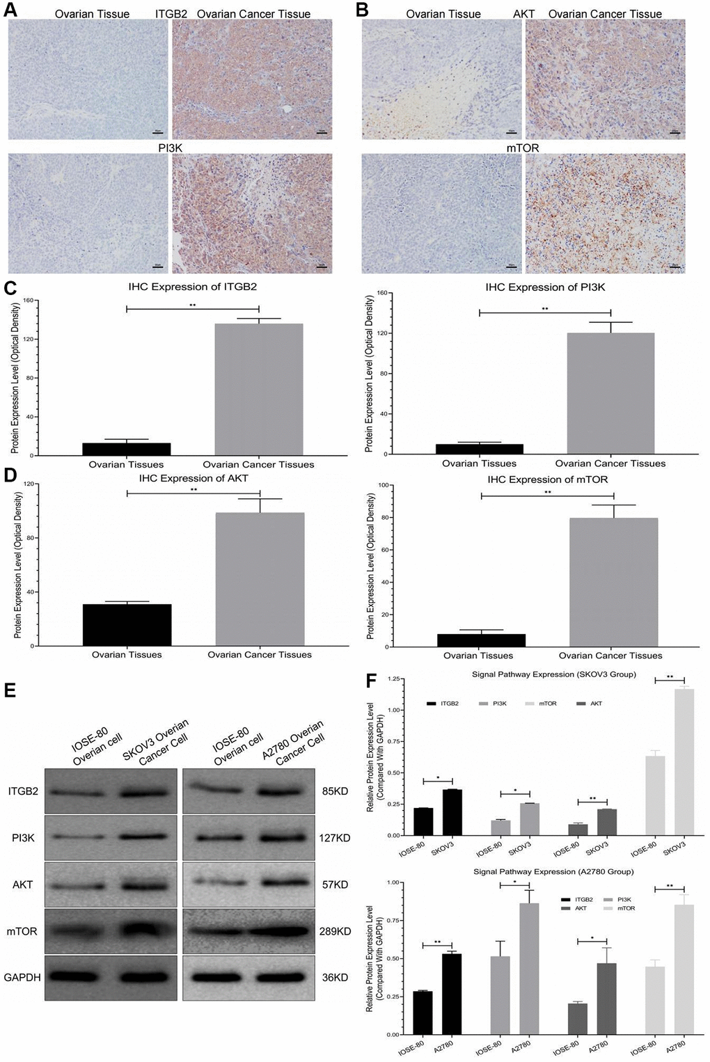 Detection of signal pathway expression in clinical samples. (A, B) Immunohistochemical detection of ITGB2-PI3K-AKT-mTOR in clinical samples (ovarian cancer and normal ovarian tissues). (C, D) Data statistics of signal axis Immunohistochemical detection in clinical samples. (E, F) WB detection of ITGB2-PI3K-AKT-mTOR in ovarian cancer cells (SKOV3 and A2780) and normal ovarian cells (IOSE-80).