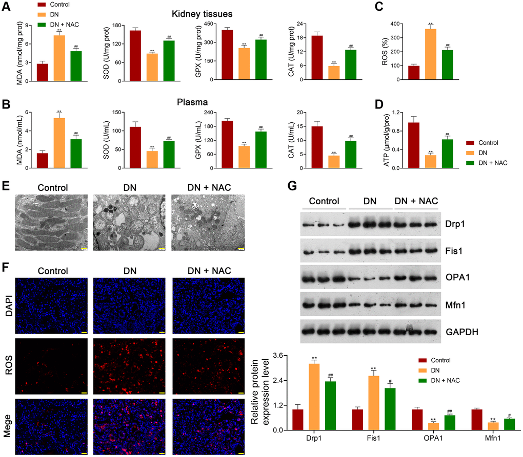 Inhibition of OS rescues mitochondrial dysfunction in DN rats. (A, B) Assessment of the levels of MDA, SOD, GPX, and CAT in the kidney tissues and plasma of rats in each group using ELISA. (C, D) ROS production and ATP release in the kidney tissues of rats in each group. (E) Observation of mitochondrial morphology under TEM (scale bar = 500 nm). (F) Mitochondrial ROS production in the kidney tissues of rats in each group (scale bar = 20 μm). (G) The expression of Drp1, Fis1, OPA1, and Mfn1 in the kidney tissues of rats in each group using western blotting. To figure out the impact of OS on mitochondrial function in DN, DN rats were treated with or without the ROS inhibitor, N-Acetylcysteine (NAC; 20 mg/kg) for eight successive weeks. Data were expressed as mean ± standard deviation (n = 6/group). **p #p##p 