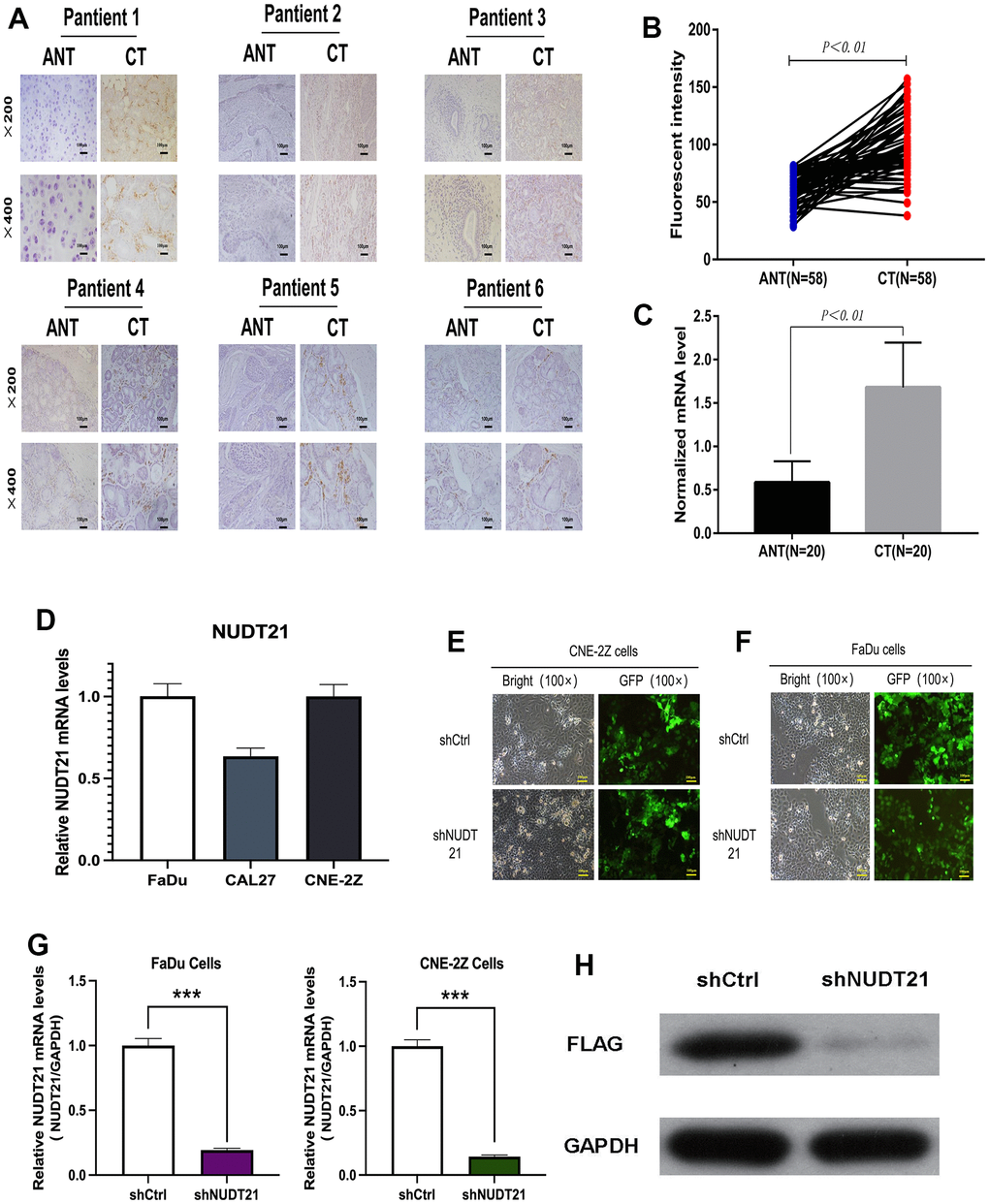 Upregulation of NUDT21 expression levels in HHNSCC and knockdown of NUDT21 by lentivirus-mediated RNAi system. (A–C) NUDT21 protein expression levels as well as gene levels in cancer tissues (CT) and paired adjacent non-tumor tissues (ANT) of 58 pairs of patients from the Second Hospital of Jilin University Cancer Center were counted by immunofluorescence method. Results included 58 pairs of patients (PD) Relative NUDT21 mRNA levels in three head and neck cancer cell lines (FaDu, CNE-2Z and CAL27). (E) Fluorescence photographs of FaDu and CNE-2Z cells infected by lentivirus (100×). (F, G) Identification of NUDT21 knockdown efficiency in FaDu and CNE-2Z cells by RT-PCR. (H) Identification of NUDT21 knockdown efficiency by FLAG protein blotting in FaDu cells. (shCtrl: control lentivirus; shNUDT21: lentivirus containing shRNA targeting NUDT21). **P 