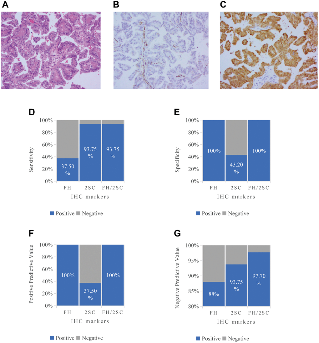 The FH-dRCC immunohistochemistry and the preliminary results of the ability of immunohistochemistry (FH, 2-SC, FH/2-SC) to diagnose FH-dRCC. (A) HE staining, 200×; (B) FH negative staining 200×; (C) 2-SC positive staining in cytoplasm/nucleus; (D) Sensitivity; (E) Specificity; (F) Positive Predictive Value; (G) Negative Predictive Value.