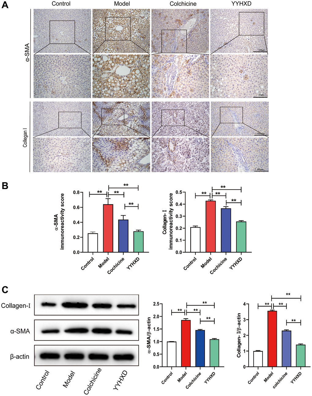 (A) a-SMA and collagen I expression in liver tissue were detected to investigate liver fibrosis. (A, B) Immunohistochemical images showed a-SMA and collagen I positive localization and positive expression rate. **P C) Western blot image showing a-SMA and collagen I expression in liver tissues. **P 