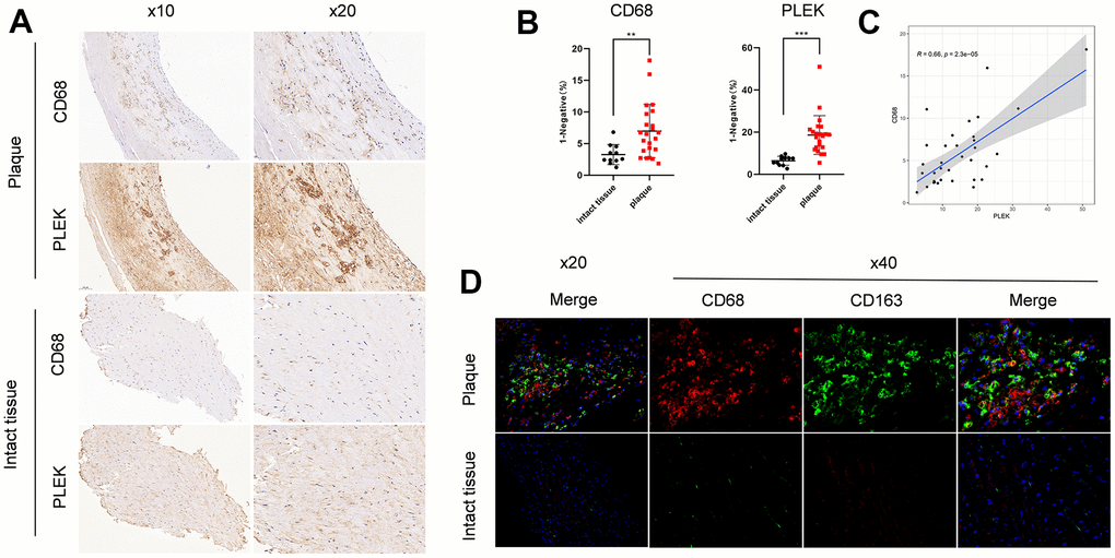 Validation of PLEK importance in carotid atherosclerotic plaque. (A) Staining images of PLEK protein expression in carotid atherosclerotic plaque and intact tissue samples. (B) Statistic of PLEK protein expression in carotid atherosclerotic plaque and intact tissue samples. (C) The scatterplot of correlation between PLEK and CD68. (D) Macrophage infiltration of plaque versus intact tissue by immunofluorescence.