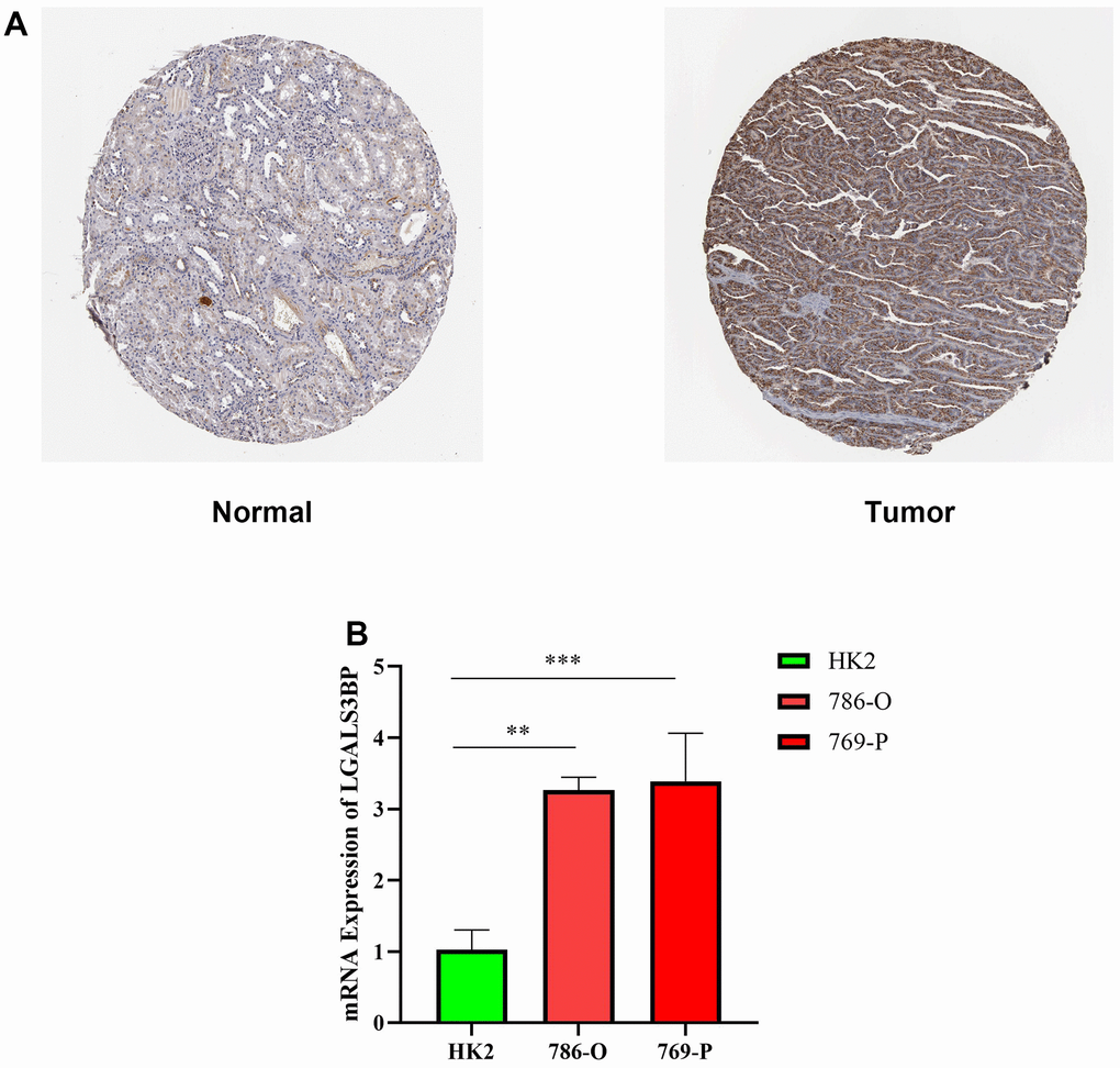 Expression level of LGALS3BP in renal clear cell carcinoma (KIRC). (A) Protein expression of LGALS3BP in KIRC. KIRC, kidney renal clear cell carcinoma. (B) The expression of LGALS3BP in ccRCC cell lines (HK2, 769, 786) was measured by the qRT-PCR. *p 