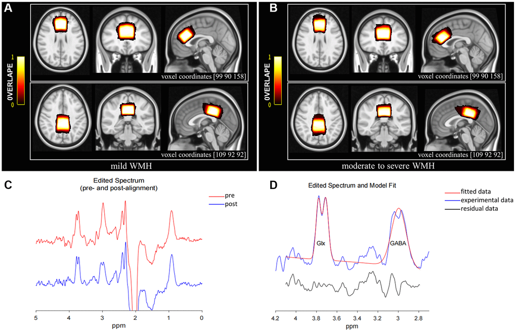 MRS voxel positions for mild WMH (A) and moderate to severe WMH participants (B). The bar color reflects the degree of overlap between individual voxels; the brighter the color, the higher the overlap. The coordinates for the transverse, coronal, and sagittal planes of the ACC are (90 90 158), while those for the PCC are (109 92 92). (C) GannetLoad output showing spectra pre (red line) and post (blue line) frequency and phase correction. (D) GannetFit output showing fitted GABA+/Cr and Glx/Cr signals: blue line, experimental data; red line, fitted data; black line, residual data. Abbreviations: ACC: anterior cingulate cortex; PCC: posterior cingulate cortex.