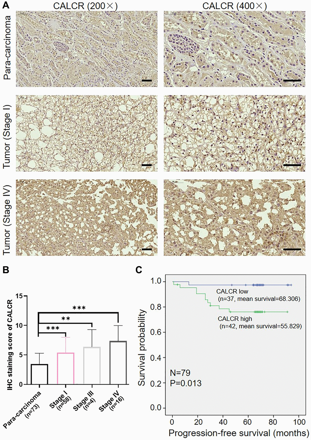 Overexpression of CALCR predicts poor prognosis for patients with renal carcinoma. (A) Representative IHC images of CALCR expression in human RCC tissues and normal para-carcinoma tissues. Scale bar represent 50 μm. (B) Quantification of CALCR expression in IHC staining. (C) Kaplan-Meier analysis indicated that high CALCR expression was correlated with short PFS. Results were presented as mean ± SD. **p ***p 