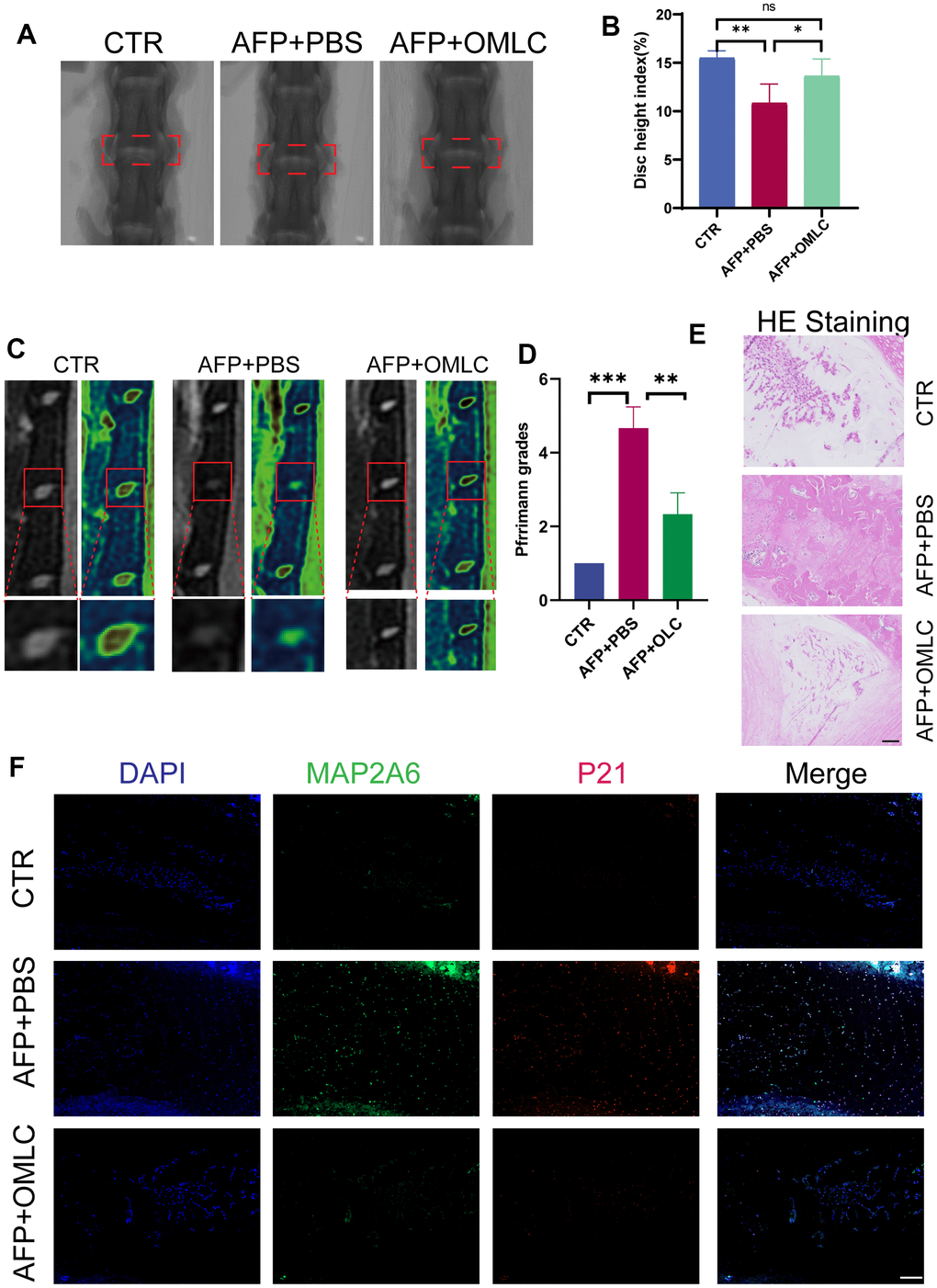 Omilancor alleviated senescence mediated IDD in vivo. (A, B) X-ray images and disc height analysis of rats from the CTR, AFP plus PBS, and AFP plus OMLC groups, taken 8 weeks post-operation. (C, D) MRI images and Pfirrmann grade analysis of rats from the CTR, AFP plus PBS, and AFP plus OMLC groups, obtained 8 weeks after surgery. (E, F) H&E and IF staining depicting MAP2K6 and P21 in rats from the CTR, AFP plus PBS, and AFP plus OMLC groups, conducted 8 weeks post-operation. (Original magnification 200×, scale bar = 200 μm). CTR, control group; AFP, annulus fibrosus puncture group; n = 3 each group. Data are represented as mean ± standard deviation. ns: not significant, *p 