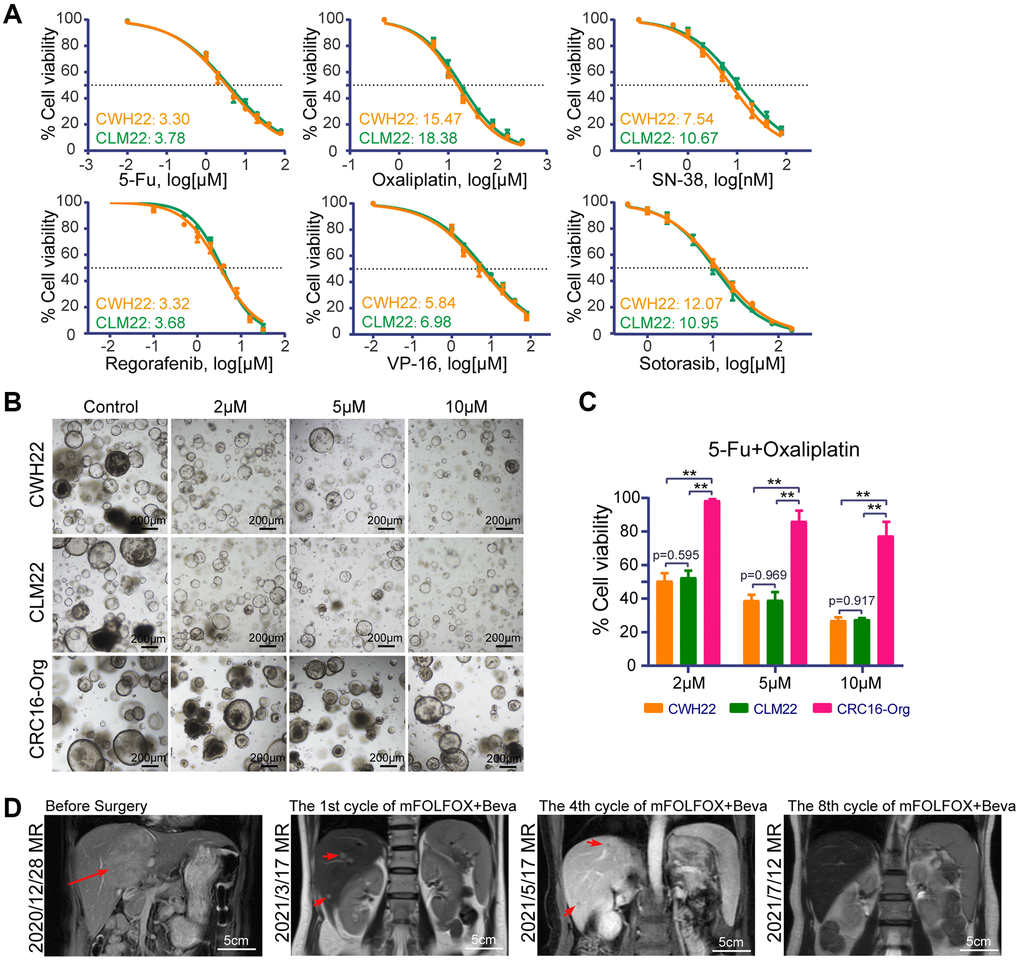 Drug treatment sensitivities of CWH22 and CLM22 organoids to traditional chemotherapies. (A) Dose-response curves of CWH22 and CLM22 organoids exposed to increasing concentrations of 5-fluorouracil, oxaliplatin, SN-38, regorafenib, VP-16, and sotorasib, and the half maximal inhibitory concentrations (IC50) of each drug. (B) Representative images of CWH22 and CLM22 organoids exposed to three concentrations of 5-Fu and oxaliplatin (2 μM, 5 μM, and 10 μM; scale bars, 200 μm). (C) Quantitative analysis of CWH22, CLM22, and CRC16-Org cell viability following exposure to different concentrations of FO combined treatment (2 μM, 5 μM, and 10 μM; n = 3; data represented as the mean ± SD, **p D) Preoperative and postoperative MRI coronal images of liver lesions during the first eight cycles treatment with mFOLFOX + bevacizumab strategies (scale bars, 5 cm).