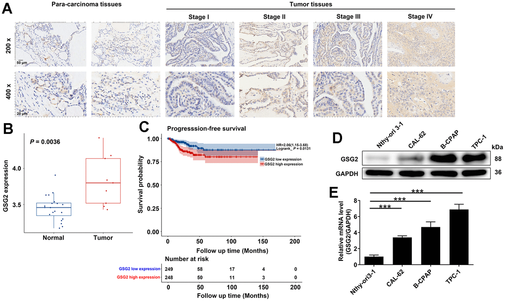 Expression of GSG2 in thyroid cancer tissues and cells. (A) Representative images of IHC analysis on GSG2 protein expression in thyroid cancer tissues compared to para-carcinoma tissues. (B) Differential expression of GSG2 in thyroid cancer compared to normal tissues based on analysis of the GSE29265 database. (C) Prognostic analysis of GSG2 expression in thyroid cancer samples from the TCGA database. (D, E) GSG2 mRNA and protein levels in Nthy-ori 3-1 and thyroid cancer cell lines (CAL-62, B-CPAP, TPC-1) were detected through western blot (D) and qRT-PCR analysis (E). Results were presented as mean ± SD. *** P 