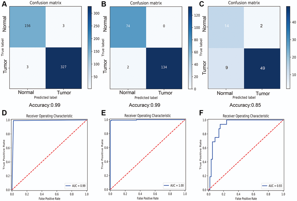 Diagnostic performance of six selected macrophage associated lncRNAs. (A) Confusion matrix of diagnostic prediction for melanoma in train dataset. (B) Confusion matrix of diagnostic prediction for melanoma in test dataset. (C) Confusion matrix of diagnostic prediction for melanoma in GSE15605 dataset. (D) Receiver operating characteristic (ROC) curve of diagnostic model in train dataset. (E) ROC curve of diagnostic model in test dataset. (F) ROC curve of diagnostic model in GSE15605 dataset.