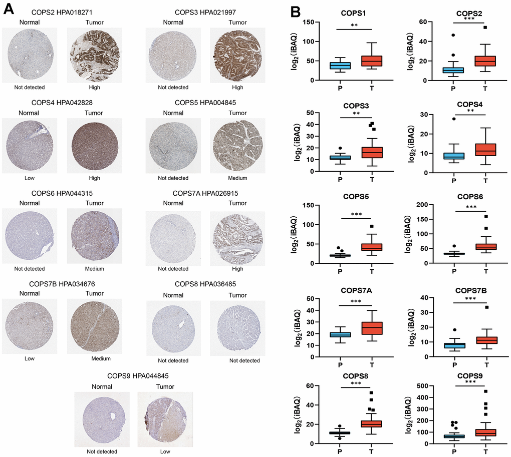 Elevated expression levels of COPS subunit proteins in HCC tissues as evidenced by immunohistochemistry (from The Human Protein Atlas). (A) Representative images of tissues immunostained with the indicated HPA antibodies. (B) Mass spectrometry-based quantitative proteomics analysis of COPS subunit proteins in HCC. **p 