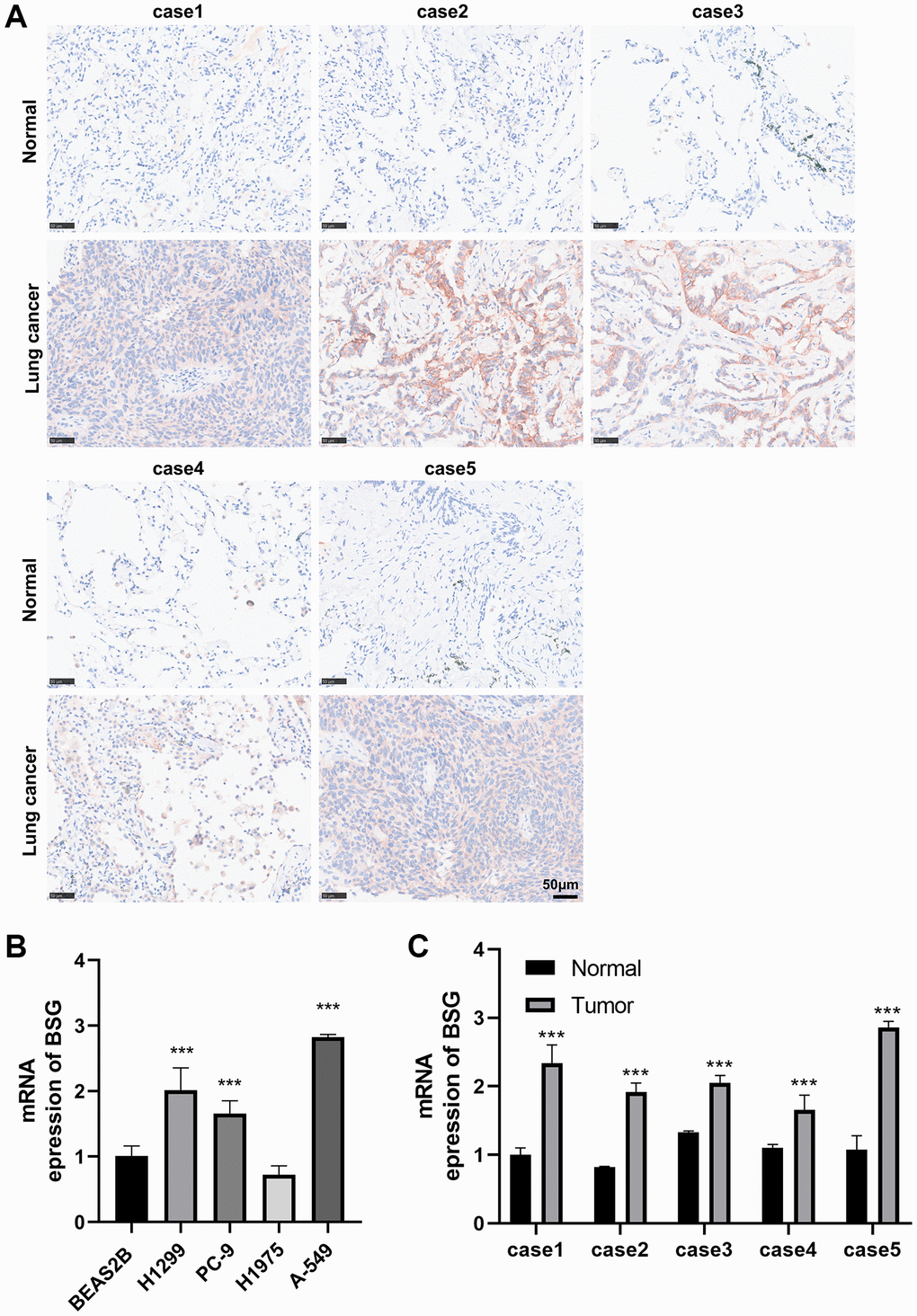 Immunohistochemical and RT-qPCR analysis of BSG expression. (A) IHC to validate the expression of BSG in five pairs lung cancer tissues. (B) qPCR to validate the expression of BSG in lung cancer cell lines. (C) qPCR to validate the expression of BSG in five pairs lung cancer tissues. ***p 