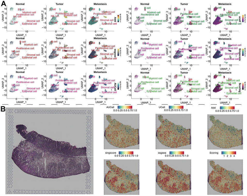 Distribution of parthanatos scores in single-cell atlas and spatial resolution. (A) Based on the UMAP algorithm, the gene set scores of 7 cell clusters were displayed in the combined samples (including normal tissue, tumor tissue and metastatic tissue). (B) Spatial transcriptome data of GC, gene set scoring under 6 gene set scoring algorithms.