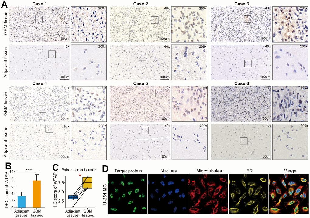 WTAP protein is upregulated in GBM tissues. (A) An immunohistochemistry assay was used to analyze the differential expression of WTAP protein in six pairs of GBM tissues and adjacent nontumor tissues. (B) The IHC scores of WTAP in GBM tissues were significantly higher than that of matched adjacent nontumor tissues. (C) Immunohistochemical detection of the WTAP expression levels in paired GBM tissues and adjacent nontumor tissues. (D) The immunofluorescence images of WTAP protein, nucleus, microtubules, and endoplasmic reticulum (ER) in U251 MG cell. *P 