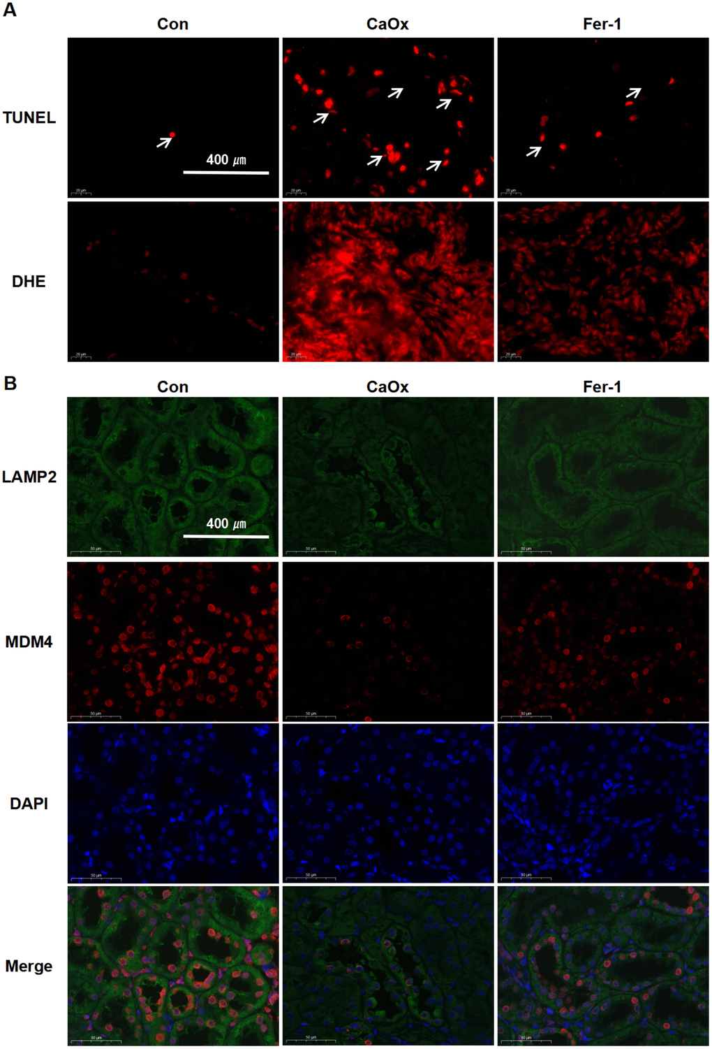 Fer-1 reduces CaOx-induced LPO and apoptosis, as well as LAMP2 and MDM4 expression in CaOx nephrolithiasis rat models. (A) TUNEL and DHE staining techniques are employed to evaluate apoptotic damage and the production of reactive oxygen species (ROS) in renal tissues (magnification×40; scale bar, 400 μm). (B) Representative immunofluorescence images show LAMP2 (green) and MDM4 (red) detection in renal tissues (magnification×40; scale bar, 400 μm).