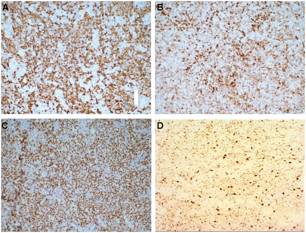 (A–D) Immunohistochemistry, medium magnification (×20), (A) Ki-67+, (B) Bcl-2+, (C) Bcl-6+, (D) MuM-1+.