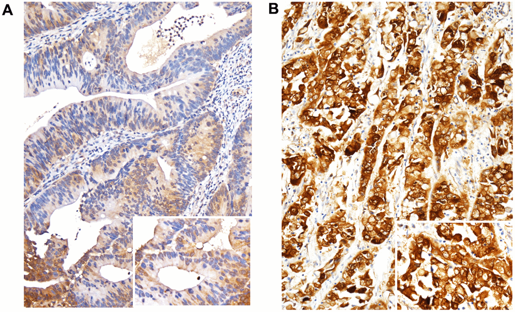 Immunohistochemical expression of FCGBP. Representative images of rectal cancer exhibiting FCGBP expression among tumor tissues. (A) Chemoradiotherapy responder with low FCGBP expression. (B) Chemoradiotherapy non-responder with high FCGBP expression. Representative images were captured at x200 magnification.