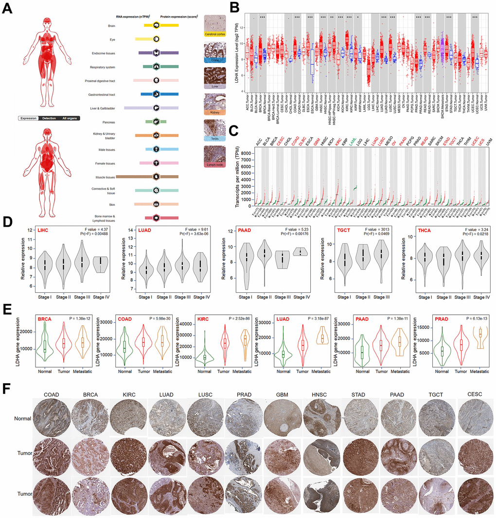 Expression pattern of LDHA in pan-cancer. (A) Summary of mRNA and protein expression. (B) The expression level of LDHA in tumor and normal tissues via TIMER 2.0. (C) LDHA expression status in different types of cancers from TCGA and GTEx data. (D) The expression of LDHA in different types of cancers (LIHC, LUAD, PAAD, TGCT, THCA) was analyzed according to pathological stage (stage I, stage II, stage III, and stage IV). (E) Differences in LDHA expression between normal, tumor, and metastatic tissues among BRCA, COAD, KIRC, LUAD, PAAD, and PRAD. (F) Based on the HPA (https://www.proteinatlas.org/) database, representative immunohistochemical staining of LDHA in normal and tumor tissues of different cancer types. The p 