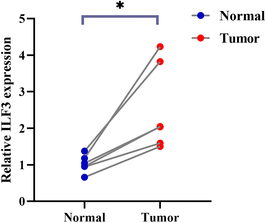 PCR test. ILF3 was highly expressed in prostate cancer tissues (*p 