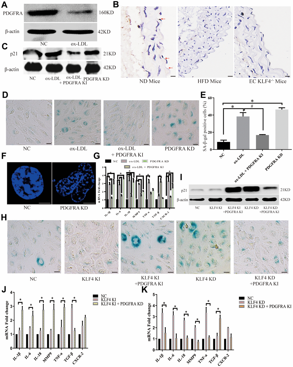 KLF4 inhibited the HUVEC SASP through PDGFRA. (A) Western blotting analysis of PDGFRA protein expression in ox-LDL-treated HUVECs (n=5). (B) Immunohistochemical detection of PDGFRA protein expression in the intima of ND-fed WT mice, HFD-fed WT mice and HFD-fed EC KLF4-/- mice. Scale bar, 200 μm. Representative images (n=5) are shown. Red arrow, PDGFRA-positive endothelial cells. (C) Western blotting analysis of p21 protein expression in ox-LDL-treated HUVECs after altered PDGFRA expression (n=5). (D) Histochemical detection of SA-β-gal-positive ECs in ox-LDL-treated HUVECs after altered PDGFRA expression. Scale bar, 50 μm. Representative images (n=5) are shown. Blue, SA-β-gal-positive ECs. (E) SA-β-gal staining positive cells were counted and presented as percentage of total cells. (F) Immunofluorescence detection of typical SAHF formation in cultured HUVECs (n=5). Scale bar, 20 μm. (G) qPCR analysis of the mRNA levels of cytokines in ox-LDL-treated HUVECs after regulating PDGFRA (n=5). *P H) Histochemical detection of SA-β-gal-positive ECs in KLF4-treated HUVECs after regulating PDGFRA. Scale bar, 50 μm. Representative images (n=5) are shown. Blue, SA-β-gal-positive ECs. (I) Western blotting analysis of p21 protein expression in KLF4-treated HUVECs after regulating PDGFRA (n=5). (J) qPCR analysis of the mRNA levels of cytokines in KLF4-knock-in HUVECs after PDGFRA knockdown (n=5). *P K) qPCR analysis of cytokine mRNA levels in KLF4-knockdown HUVECs after PDGFRA knock-in (n=5). *P 