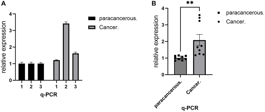RT-PCR demonstrated the expression level of IL18 in breast cancer tissues. (A) RT-PCR assay was used to show the difference in IL18 transcript levels in a single sample between the experimental and control groups. (B) RT-PCR experiments showing group differences in IL18 gene expression levels between tumor and normal groups. One-way ANOVA and Tukey’s Method were used to test significance *p **p ***p 