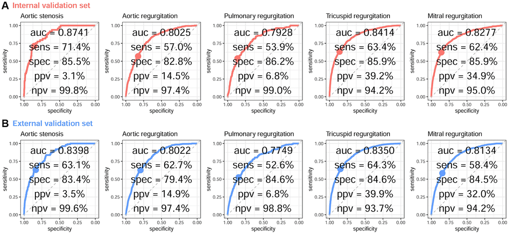 ROC curve analysis for VHD from a DLM based on age, sex, and ECG voltage–time traces. The receiver operating characteristic (ROC) curve (x-axis = specificity and y-axis = sensitivity) and area under the ROC curve (AUC) were calculated using the internal validation set (A) and external validation set (B). The operating point was selected based on the maximum Youden’s index in the tuning set, which was used for calculating the corresponding sensitivities and specificities in the two validation sets.