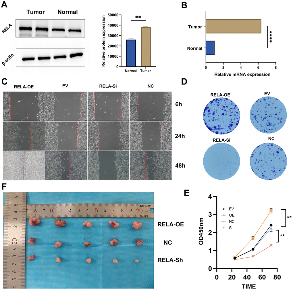 Promotion of tumor cell proliferation by RELA. (A, B) Differential expression of RELA in tumor vs. normal tissues, with pronounced upregulation in tumor samples. (C) Microscopic images highlighting cell migration differences across treatments over time. (D) Varying clonogenic potential among treatments, notably between RELA-OE and RELA-Si. (E) Results of the CCK-8 assay presenting enhanced proliferation in the RELA-OE group. (F) In vivo tumor size differences, with RELA-OE tumors being significantly larger.