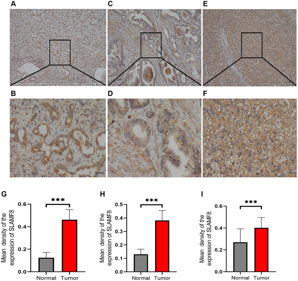 Representative immunohistochemical staining of SLAMF8 in HCC, PRAD and KIRC tissues. (A) Positive expression of SLAMF8 in HCC tissue, Magnification ×100. (B) Positive expression of SLAMF8 in HCC tissue, Magnification ×400. (C) Positive expression of SLAMF8 in PRAD tissue, Magnification ×100. (D) Positive expression of SLAMF8 in PRAD tissue, Magnification ×400. (E) Positive expression of SLAMF8 in KIRC tissue, Magnification ×100. (F) Positive expression of SLAMF8 in KIRC tissue, Magnification ×400. (G–I) Different expression of SLAMF8 in HCC, PRAD, KIRC tissue and matched adjacent noncancerous tissues. *P **P ***P 