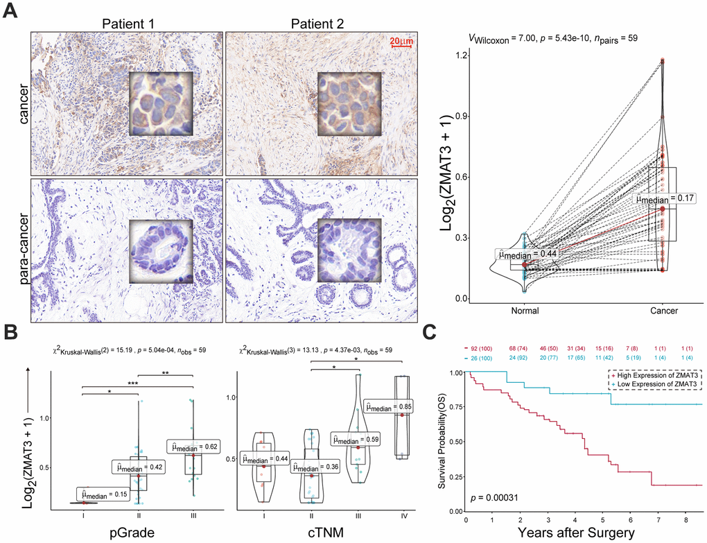 (A) Left: representative IHC images of ZMAT3 in breast cancer and the corresponding para-cancerous mammary duct. Scale bar = 20 μm. Right: the MOD values for the staining scores. (B) The correlations of MOD value of ZMAT3 with pathological grade (left) and clinical TNM stage (right), respectively. (C) Kaplan-Meier survival analysis for breast cancer patients with higher and lower expression levels of ZMAT3.