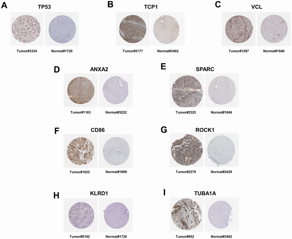 The immunohistochemistry staining of protein in human liver tissue, as sourced from the Human Protein Atlas version 23.0. (A) The immunohistochemical staining of the TP53 protein in the liver tissue of patients with liver cancer (Tumor#3334) is available from https://images.proteinatlas.org/39238/82313