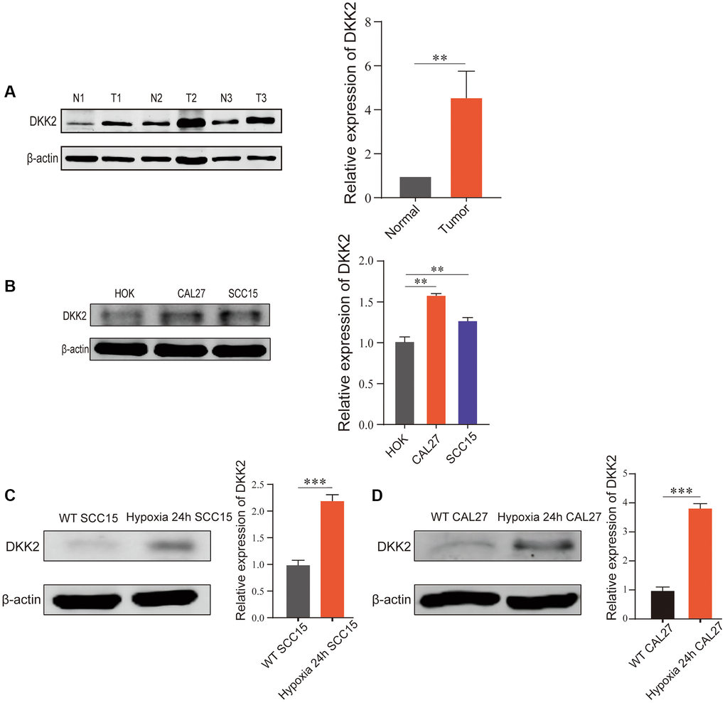 DKK2 expression differences in oral squamous cell carcinoma. (A) DKK2 protein expression in human oral squamous cell carcinoma tissues (T) and normal oral mucosa tissues (N). (B) DKK2 protein expression in HOK, CAL27, and SCC15. (C) DKK2 expression in hypoxic and normoxic in SCC15 cell. (D) DKK2 expression in hypoxic and normoxic in CAL27 cell. *p **p ***p ****p 