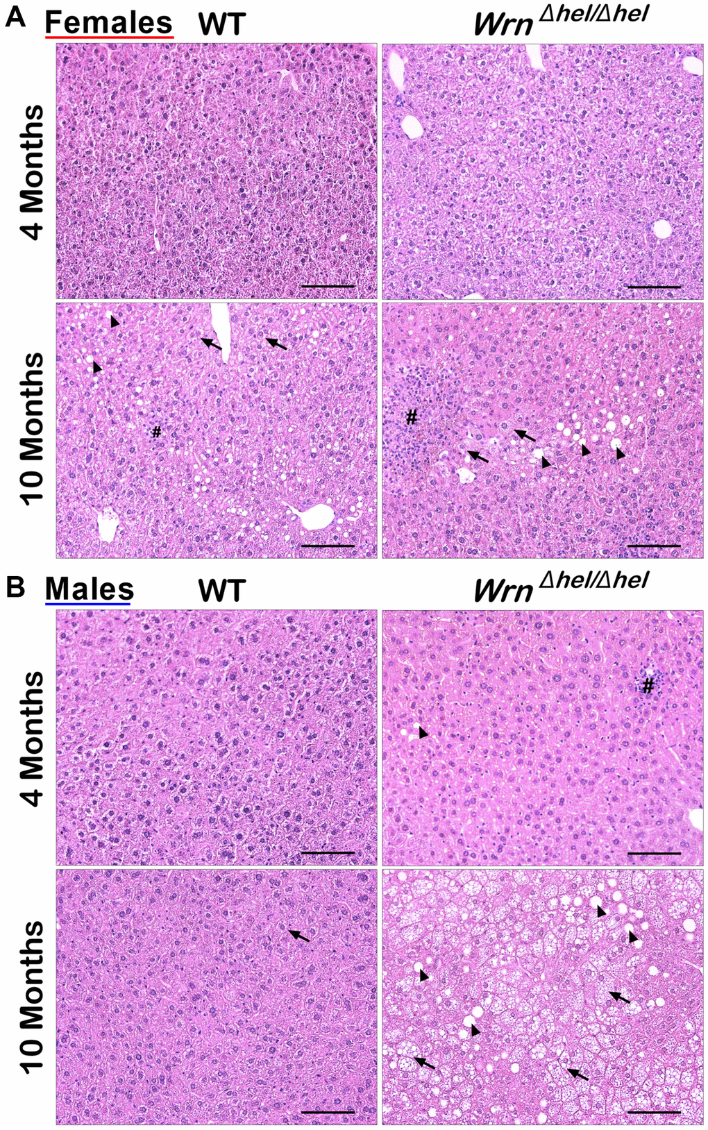 Representative histology of the liver in wild type and WrnΔhel/Δhel mice at four and ten months of age. (A) Representative histological sections from females. (B) Representative histological sections from males. All photomicrographs: hematoxylin and eosin; magnification 200X. Scale bars on the images represent 100 μm. # = inflammatory cell aggregation; arrowheads = macrovesicles; arrows = cytoplasmic microvesicles.